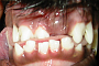 preview: Fehlende Zähne bei Welpen (Hund)