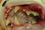 preview: Stomatitis/ massive Zahnfleischentzündung