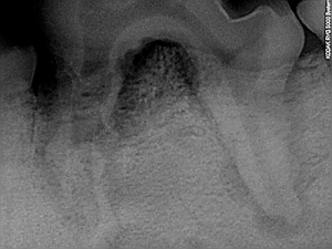 Original Röntgenbild - zweiwurzliger Zahn mit verdeckter Parodontitis