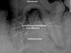 Beschriftetes Röntgenbild - zweiwurzliger Zahn mit verdeckter Parodontitis