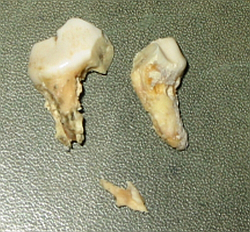 Extrahierter zweiwurzliger Zahn mit verdeckter Parodontitis