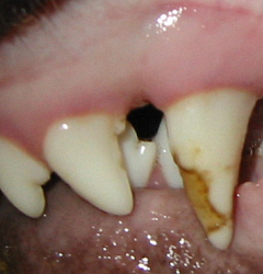 Bleibender Zahn mit Schmelzhypoplasie/Schädigung verursacht durch unbehandelten gebrochenen Milchzahn